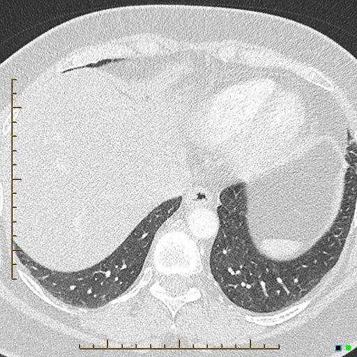 Bronchial diverticula (Radiopaedia 79512-92676 Axial lung window 171).jpg