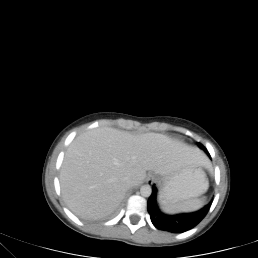 Bronchial mucoepidermoid carcinoma (Radiopaedia 57023-63895 Axial 87).jpg