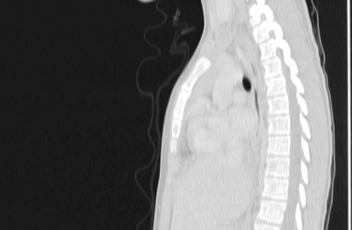 Bronchial mucoepidermoid carcinoma (Radiopaedia 57023-63895 Sagittal lung window 86).jpg