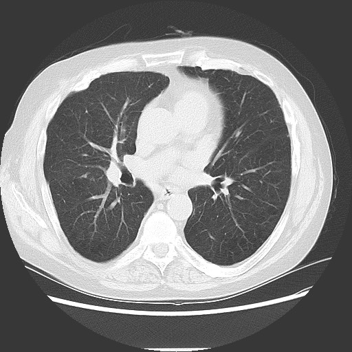 Bronchial stenosis - lung transplant (Radiopaedia 73133-83848 Axial lung window 34).jpg