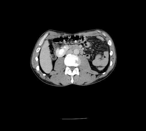 File:Bronchiectasis in Crohn disease (Radiopaedia 60311-67977 B 82).jpg