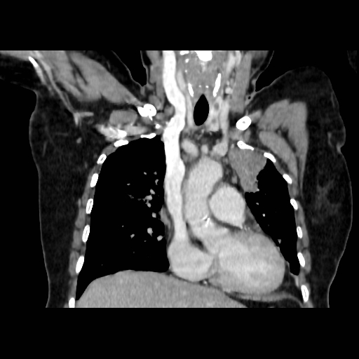 Bronchogenic carcinoma (Radiopaedia 73497-84262 C 55).jpg