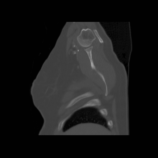 File:Bronchogenic carcinoma (Radiopaedia 73497-84262 Sagittal bone window 26).jpg