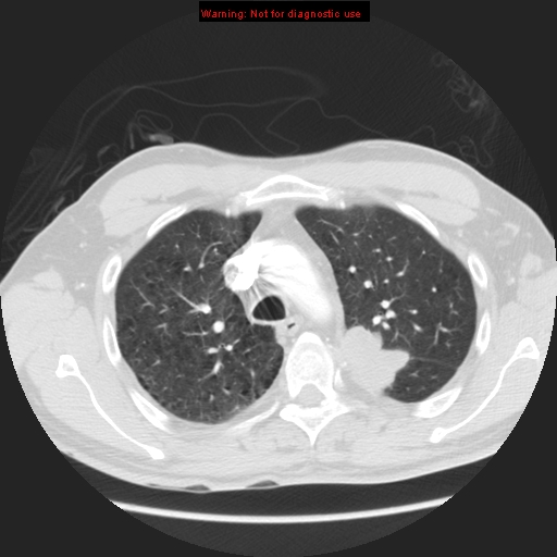 File:Bronchogenic carcinoma brain metastasis (Radiopaedia 9286-105832 Axial lung window 20).jpg