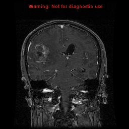 File:Bronchogenic carcinoma brain metastasis (Radiopaedia 9286-9969 Coronal T1 10).jpg