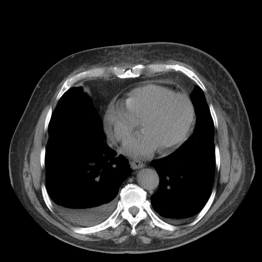 Bronchogenic carcinoma with metastatic lymphadenopathy (Radiopaedia 37671-39569 Axial non-contrast 37).jpg