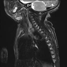 File:Bronchogenic cyst (Radiopaedia 27207-27380 Sagittal STIR 2).jpg