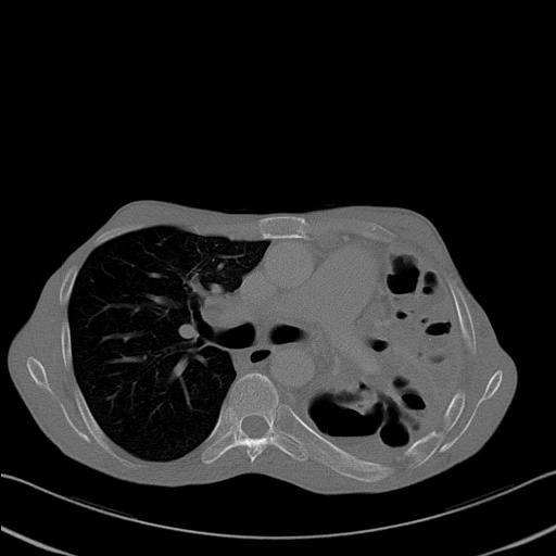File:Bronchopleural fistula secondary to tuberculosis (Radiopaedia 20415-20322 Axial bone window 13).jpg