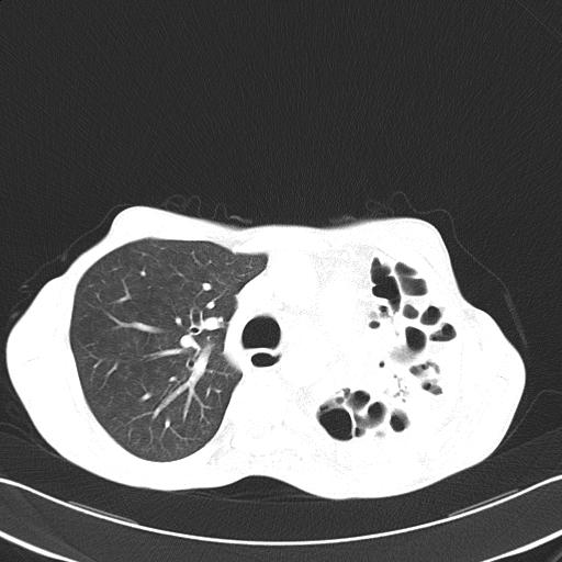 Bronchopleural fistula secondary to tuberculosis (Radiopaedia 20415-20322 Axial lung window 22).jpg