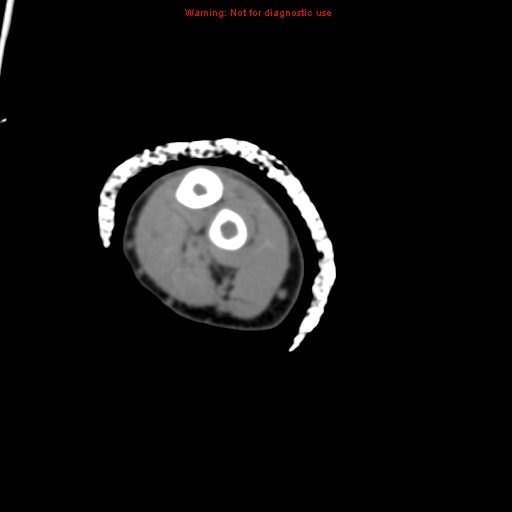 Brown tumor (Radiopaedia 12460-12694 Axial non-contrast 114).jpg
