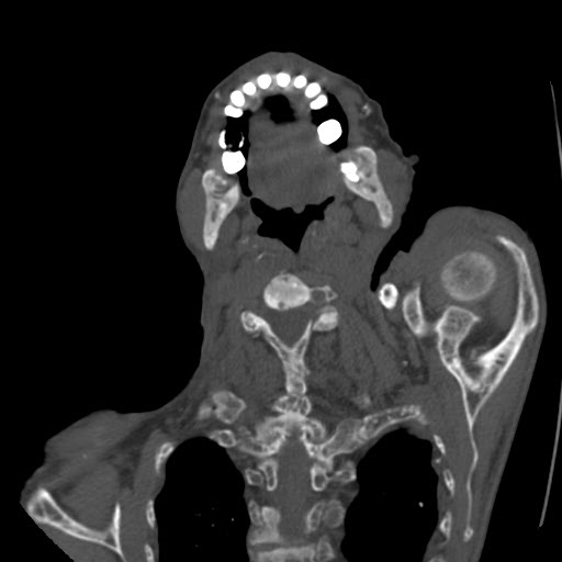 File:Brown tumor with secondary hyperparathyroidism (Radiopaedia 23591-23705 C 19).jpg