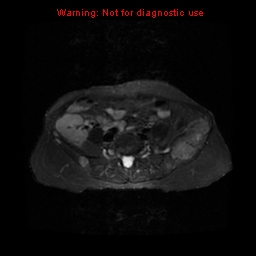File:Brown tumors (Radiopaedia 9666-10290 Axial T2 fat sat 3).jpg
