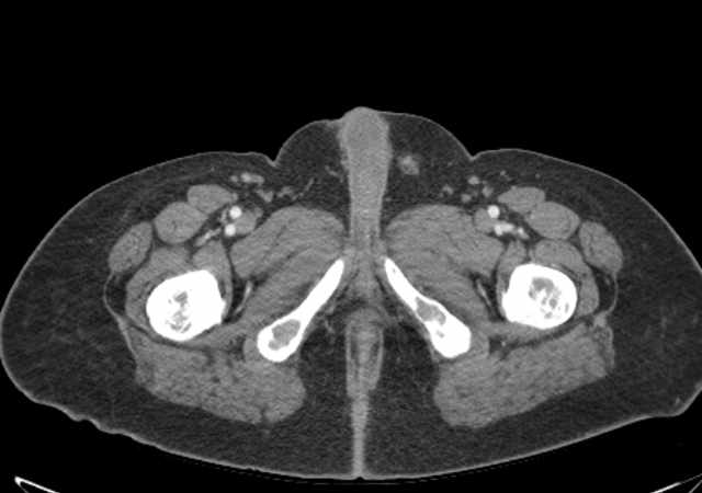 Brown tumors compressing the spinal cord (Radiopaedia 68442-77988 E 137).jpg