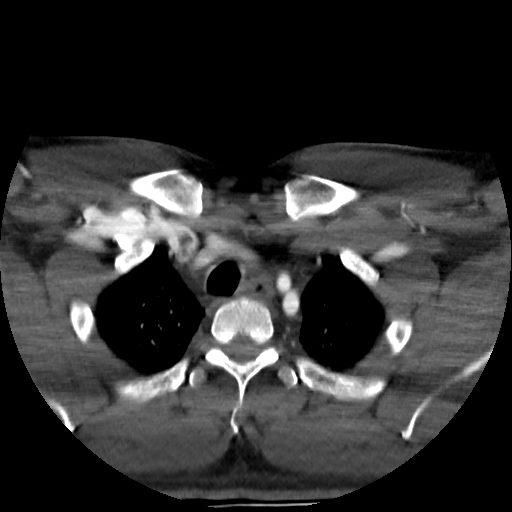 Buccal fat pad arteriovenous malformation (Radiopaedia 70936-81144 A 100).jpg
