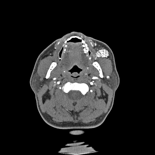 Buccal fat pad arteriovenous malformation (Radiopaedia 70936-81144 D 192).jpg