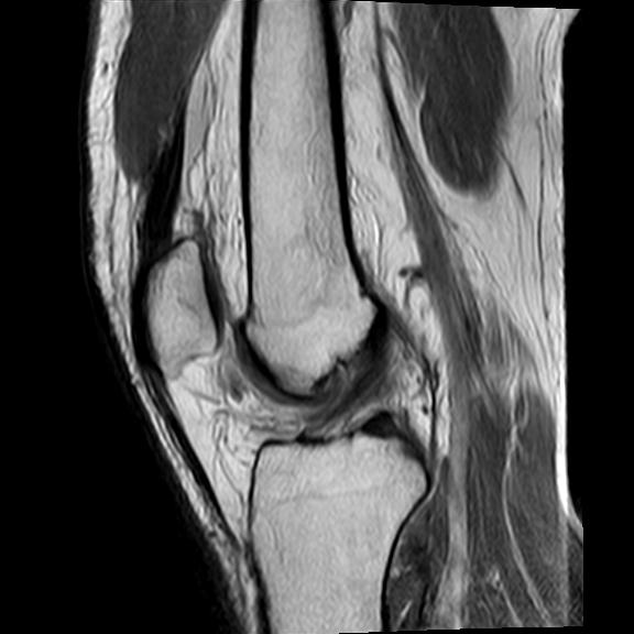 File:Bucket handle tear - medial meniscus (Radiopaedia 29250-29664 Sagittal PD 10).jpg
