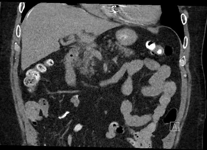 Buried bumper syndrome - gastrostomy tube (Radiopaedia 63843-72577 Coronal Inject 59).jpg