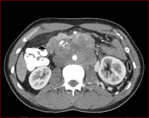File:Burned-out testicular choriocarcinoma (Radiopaedia 32822-34040 B 9).PNG
