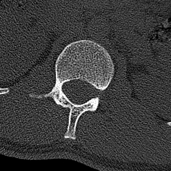 Burst fracture (Radiopaedia 53373-59357 Axial bone window 13).jpg