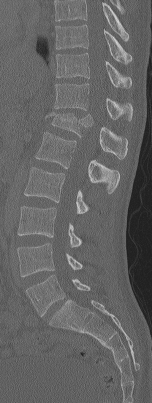 Burst fracture - T12 with conus compression (Radiopaedia 56825-63647 Sagittal bone window 41).png