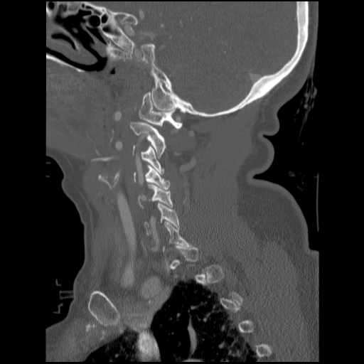 File:C1 anterior arch (plough) fracture - type 1 (Radiopaedia 76181-87720 Sagittal bone window 73).jpg