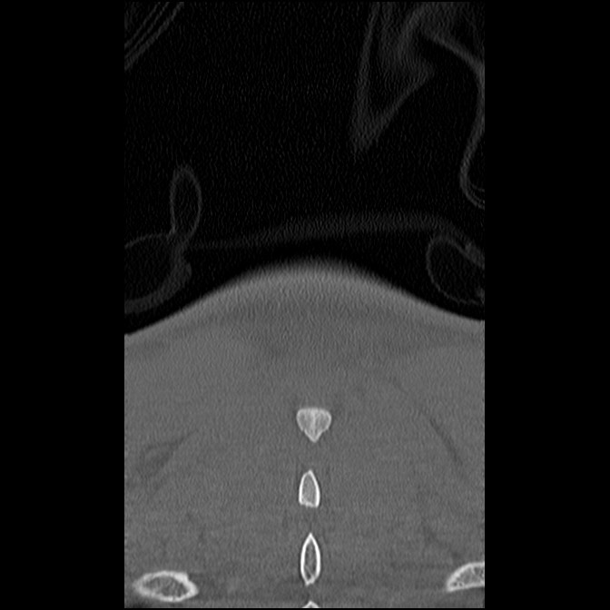 C5 facet fracture (Radiopaedia 58374-65499 Coronal bone window 61).jpg