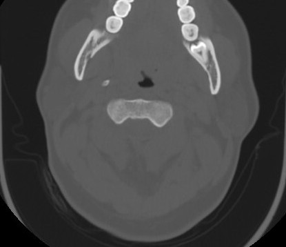 File:C7 laminar fracture and Klippel-Feil syndrome (Radiopaedia 86710-102850 Axial bone window 28).jpg