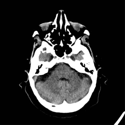 File:CNS Lymphoma (Radiopaedia 44198-47794 Axial non-contrast 10).png