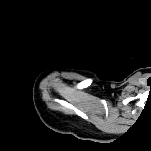 File:Calcific tendinitis of the infraspinatus tendon (Radiopaedia 87256-103539 B 16).jpg