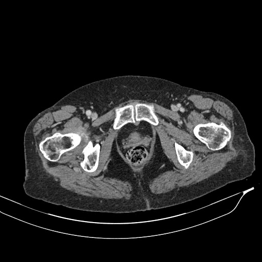 Calcified adrenal glands and Spigelian hernia (Radiopaedia 49741-54988 A 247).jpg