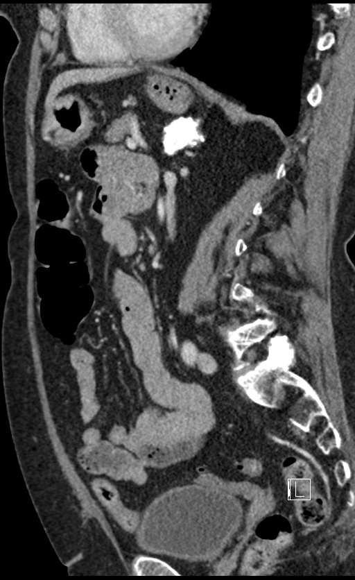 Calcified adrenal glands and Spigelian hernia (Radiopaedia 49741-54988 C 67).jpg