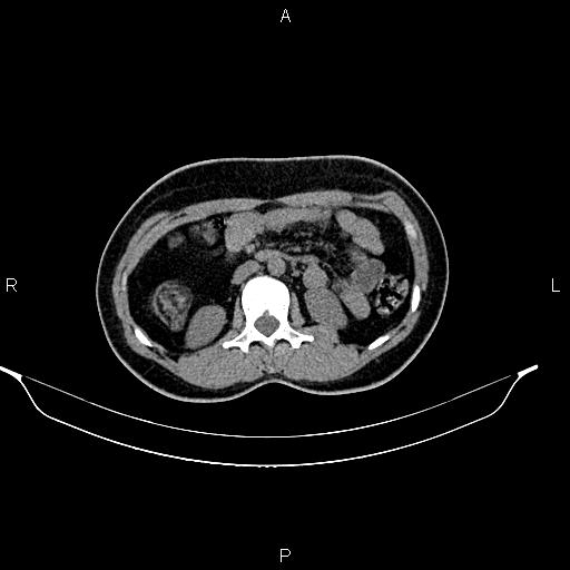 File:Calcified hepatic hydatid cyst (Radiopaedia 84672-100095 Axial non-contrast 47).jpg