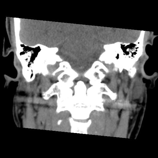 Calcifying pseudoneoplasm of neuraxis (Radiopaedia 44076-47617 Coronal non-contrast 25).png