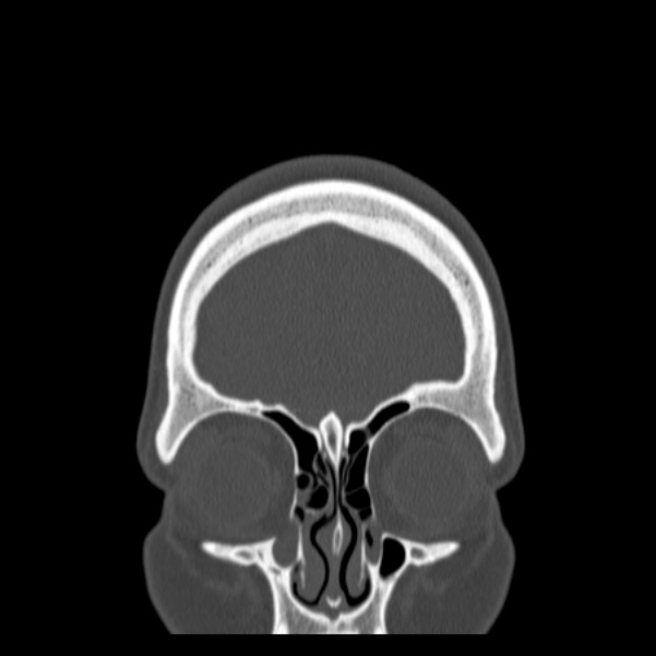 Calvarial osteoma (Radiopaedia 36520-38079 C 16).jpg