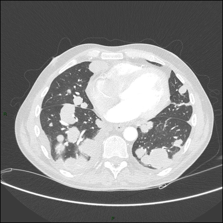 Cannonball metastases (Radiopaedia 82110-96150 Axial lung window 131).jpg