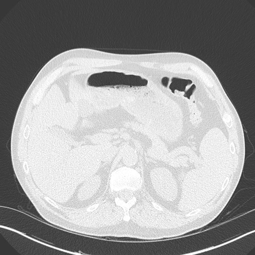 Caplan syndrome (Radiopaedia 56667-63530 Axial lung window 195).jpg