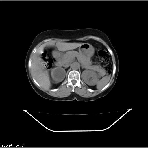 File:Carcinoma cervix- recurrence (Radiopaedia 34702-36137 Axial non-contrast 15).jpg