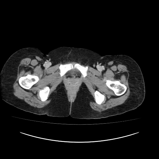 File:Carcinoma colon - hepatic flexure (Radiopaedia 19461-19493 A 132).jpg