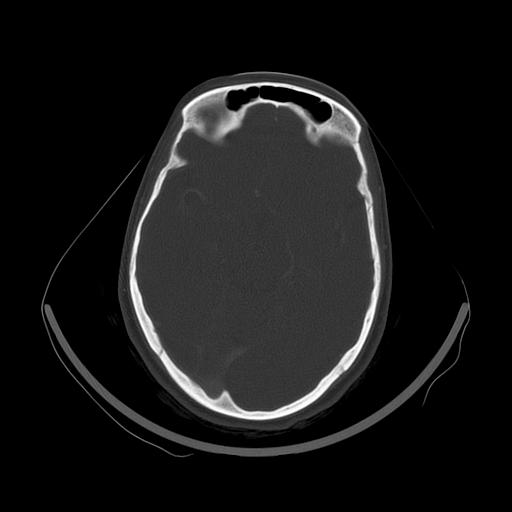 Carcinoma of the maxillary antrum (Radiopaedia 53805-59888 Axial bone window 2).jpg
