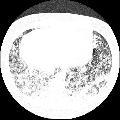File:Cardiac angiosarcoma (Radiopaedia 66010-75181 Axial lung window 16).jpg