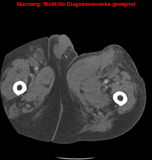 File:Cardiac perforation following transcatheter aortic valve implantation (Radiopaedia 23714-23863 B 26).png