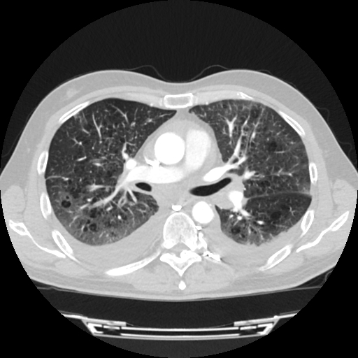 Cardiac tamponade (Radiopaedia 78607-91368 Axial lung window 37).jpg