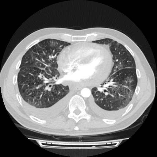 Cardiac tamponade (Radiopaedia 78607-91368 Axial lung window 54).jpg