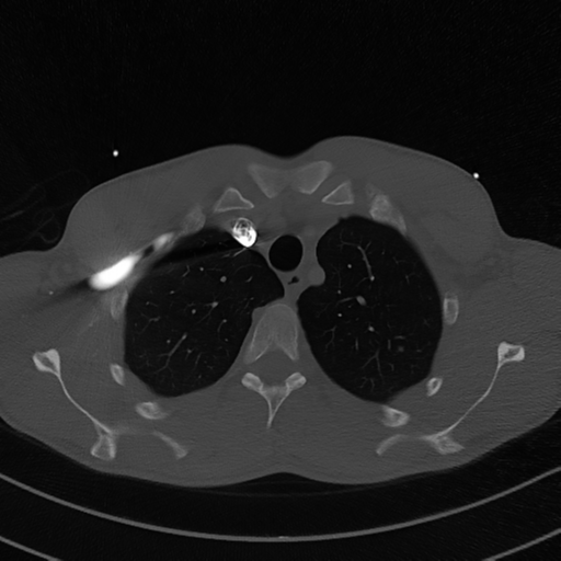 Cardiac tumor - undifferentiated pleomorphic sarcoma (Radiopaedia 45844-50134 Axial bone window 14).png