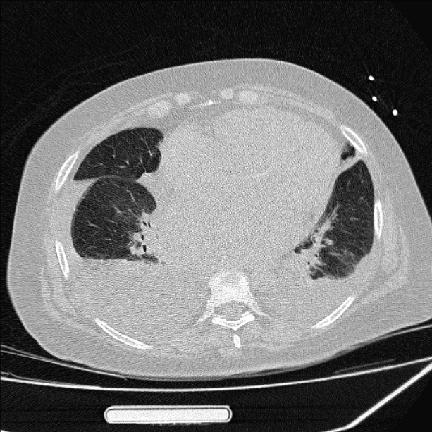 Cardiogenic pulmonary edema (Radiopaedia 29213-29609 Axial lung window 65).jpg