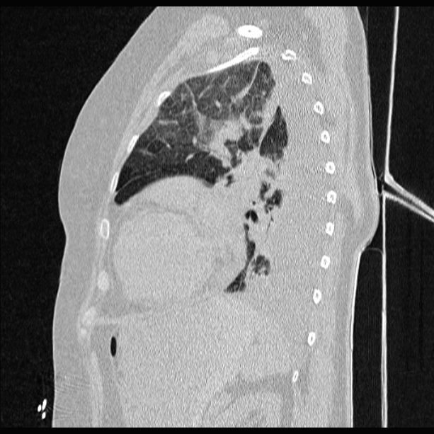 Cardiogenic pulmonary edema (Radiopaedia 29213-29609 Sagittal lung window 69).jpg