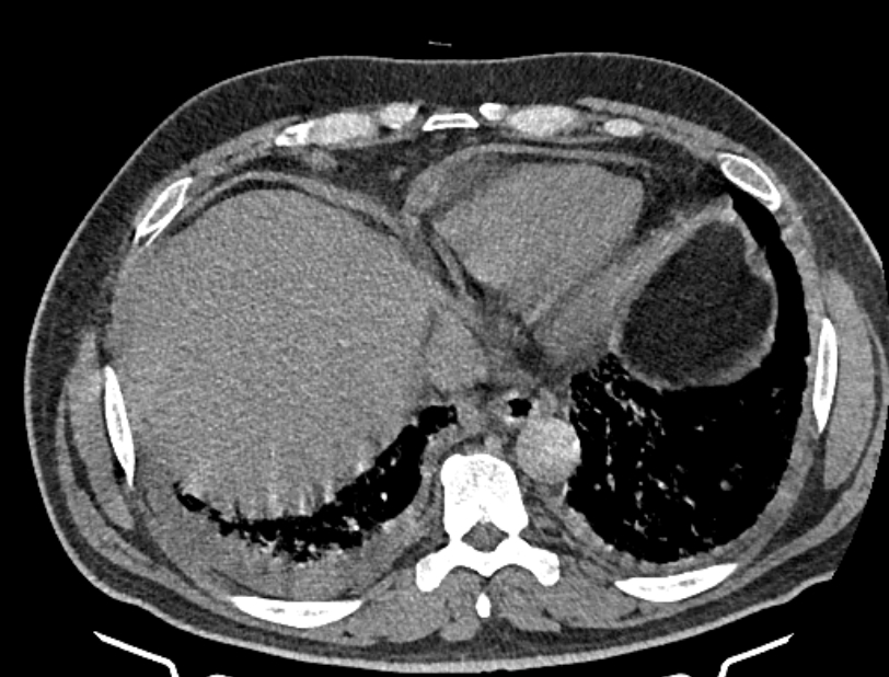 Cardiogenic pulmonary edema (Radiopaedia 68180-77678 Axial non-contrast 43).jpg