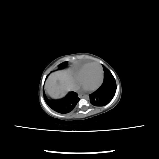 File:Caroli disease with autosomal recessive polycystic kidney disease (ARPKD) (Radiopaedia 89651-106703 E 11).jpg
