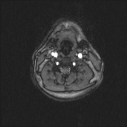 Carotid artery dissection (Radiopaedia 28441-28689 Axial MRA 38).jpg