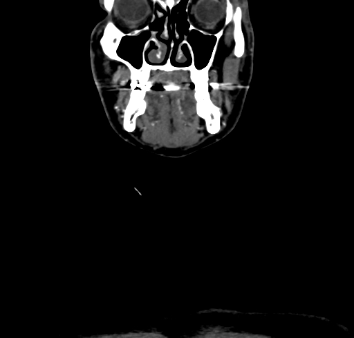 File:Carotid body tumor (Radiopaedia 83615-98727 B 20).jpg